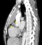 Axial and sagital reconstruction from a contrast enhanced chest CT at the level of the ascending aorta demonstrates an anterior medastinal mass. The mass shows a small regions of heterogeneity with a low attenuation region, and abuts the anterior aspect of the pericardium<strong>(arrows)</strong>. There is a lobulated contour that abuts the lung . At surgery, the thymoma was found to invade the medaistinal fat as well as the right lung, without invasion into the aorta or other mediastinal vessels .